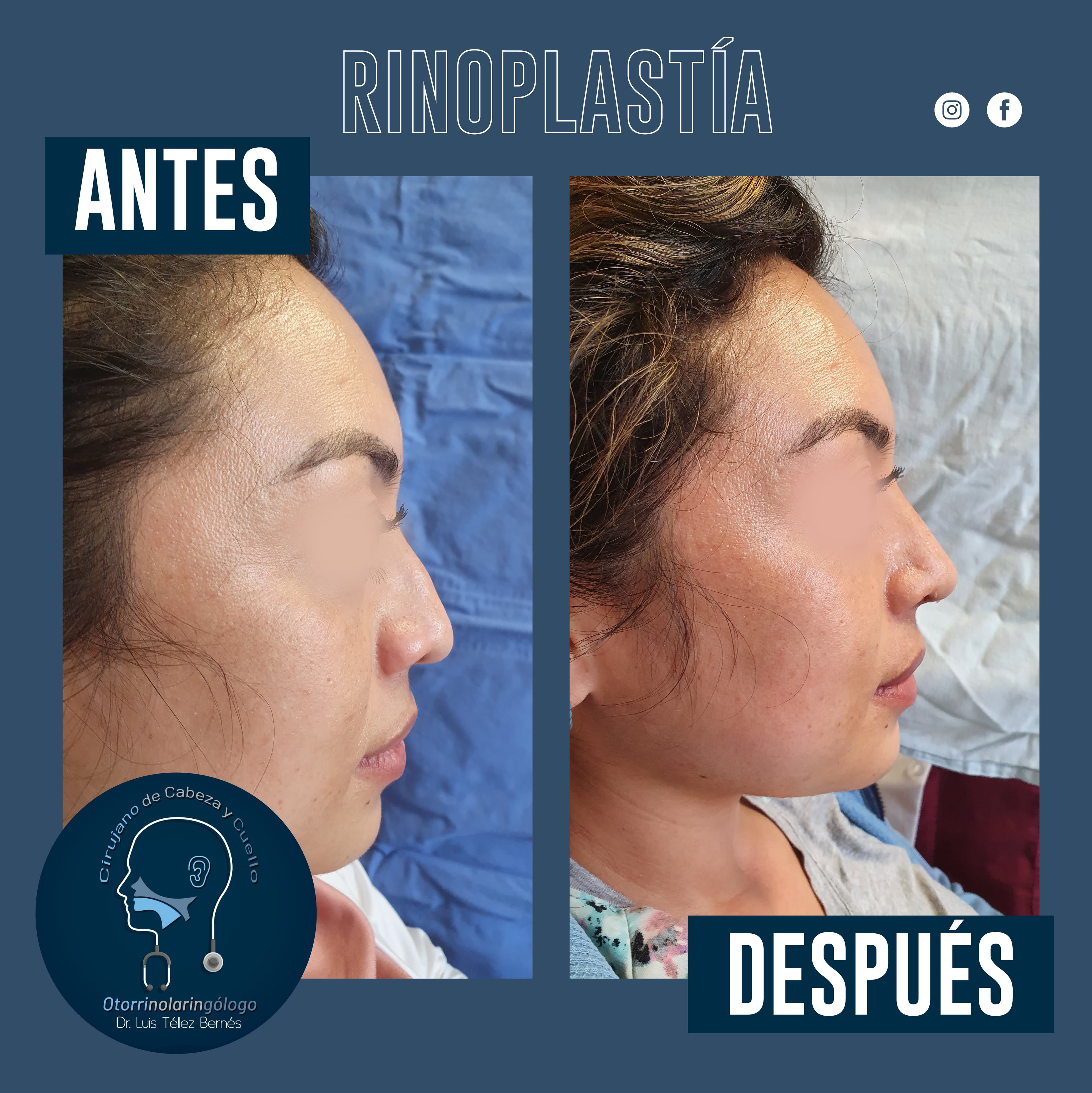 Resultado de tratamiento 2